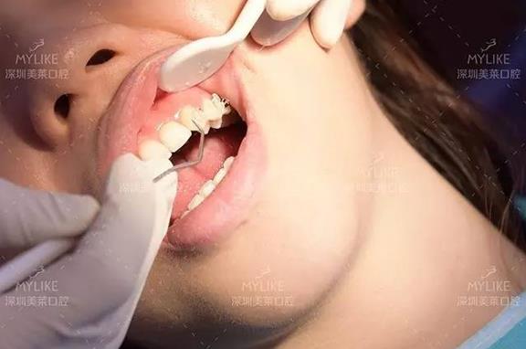 美女矫正牙齿